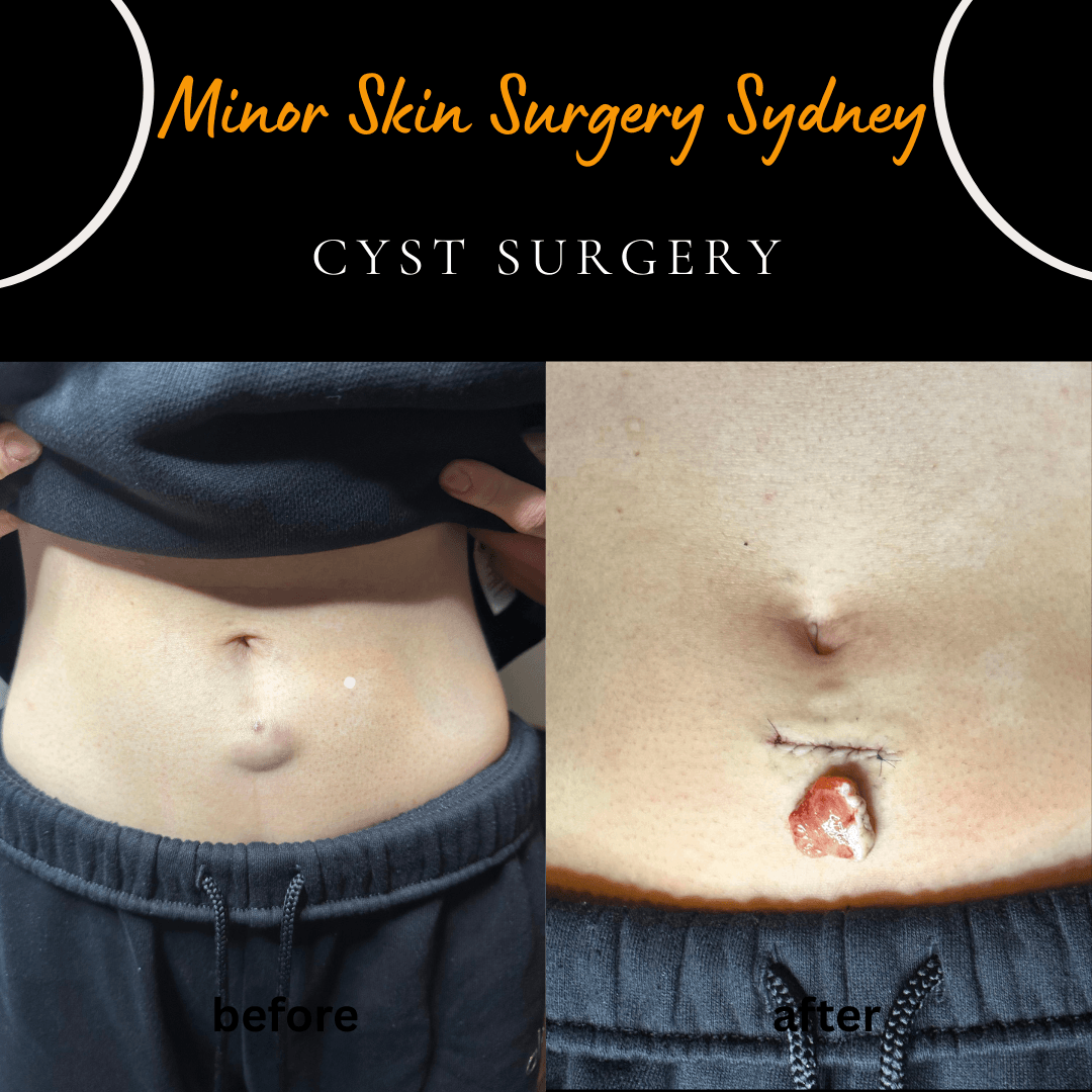 before and after surgeyr photo after same day cyst surgery under local anaestehsia by Dr Peter Kim in Chatswood rooms