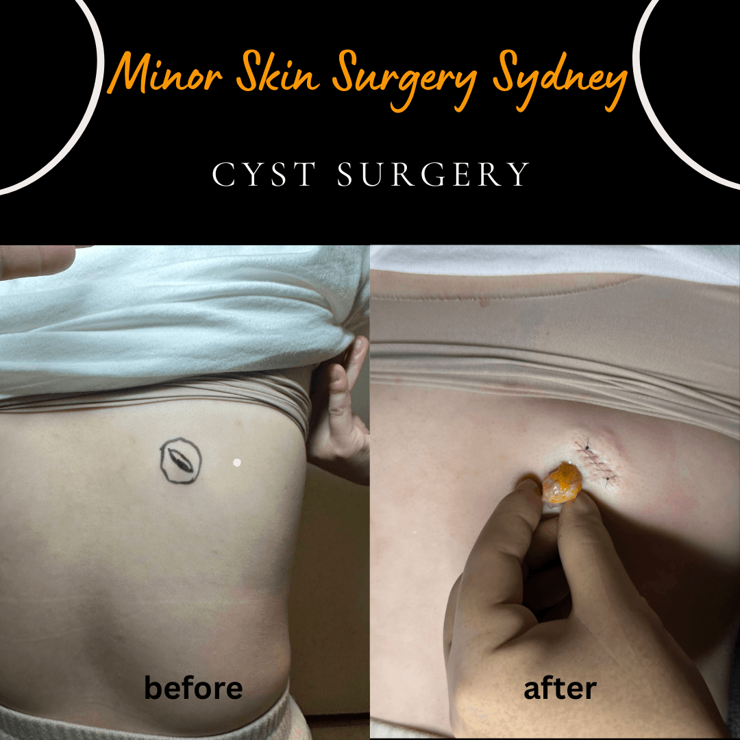 How long does it take for Dr peter Kim to remove a cyst under local anaesthesia?