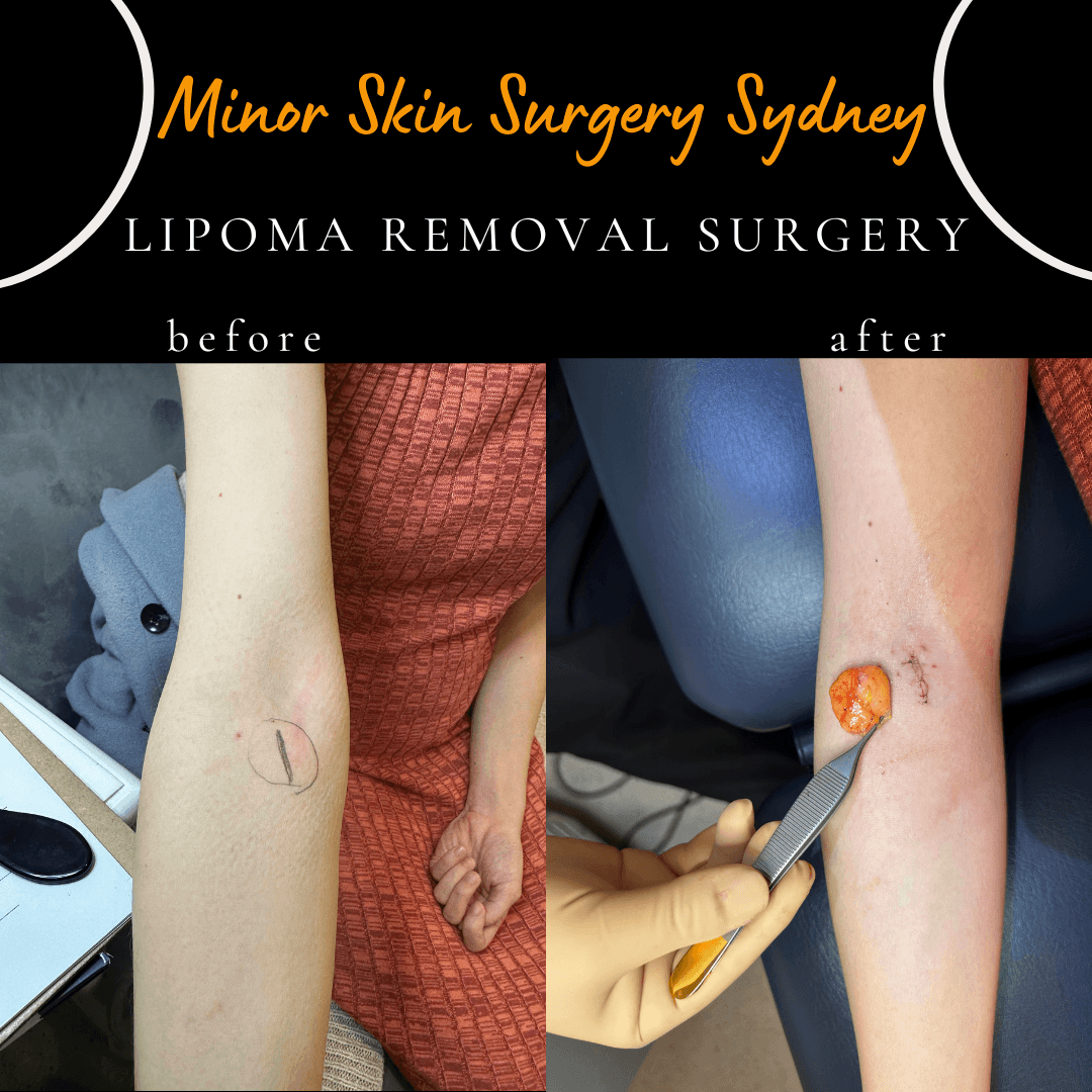 Before and After photo of lipoma surgery on elbow, same day surgery under local anaesthesia in cabramatta clinic sydney