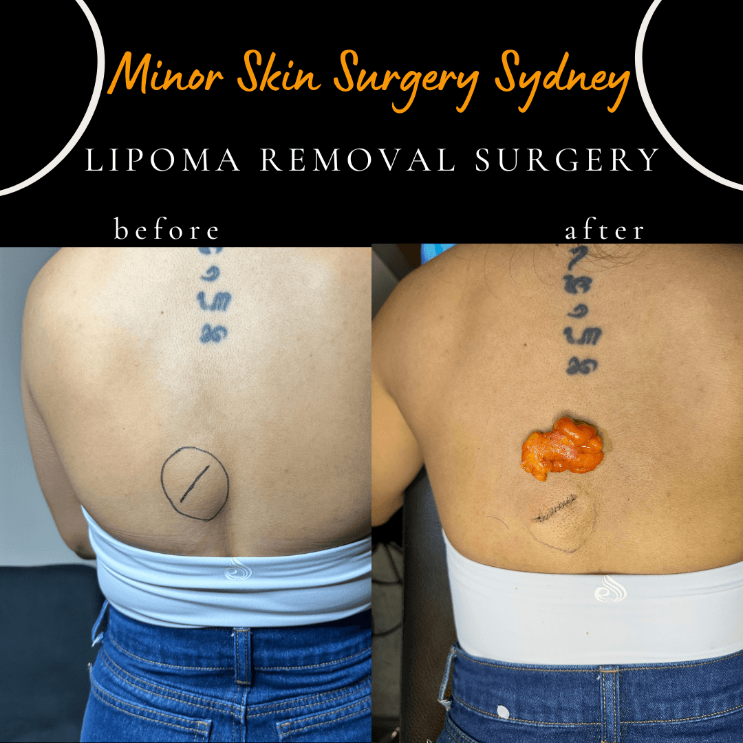 Back lipoma successfully excised under local anaesthesia.