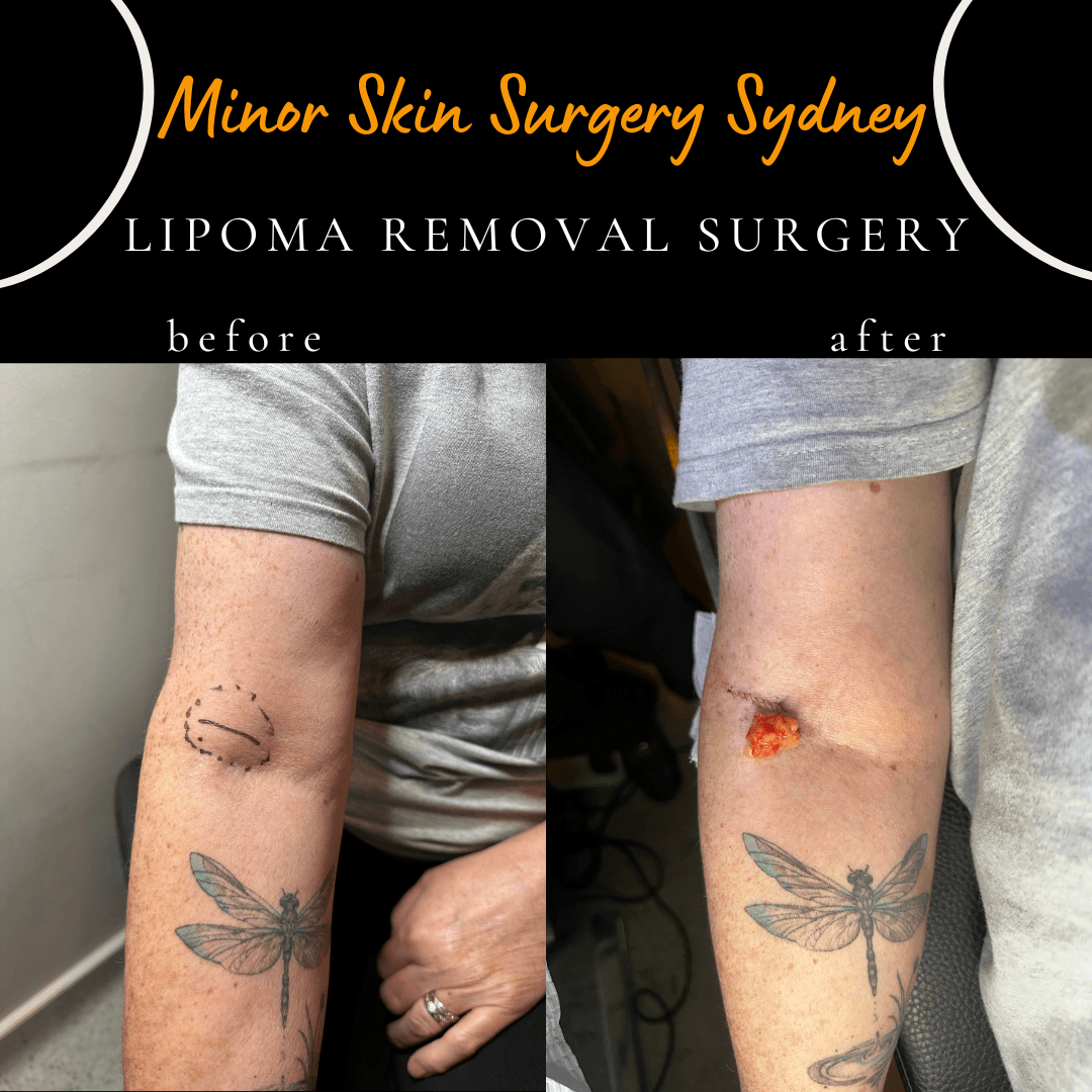 Same-day lipoma removal from the elbow area under local anaesthesia. Cabramatta