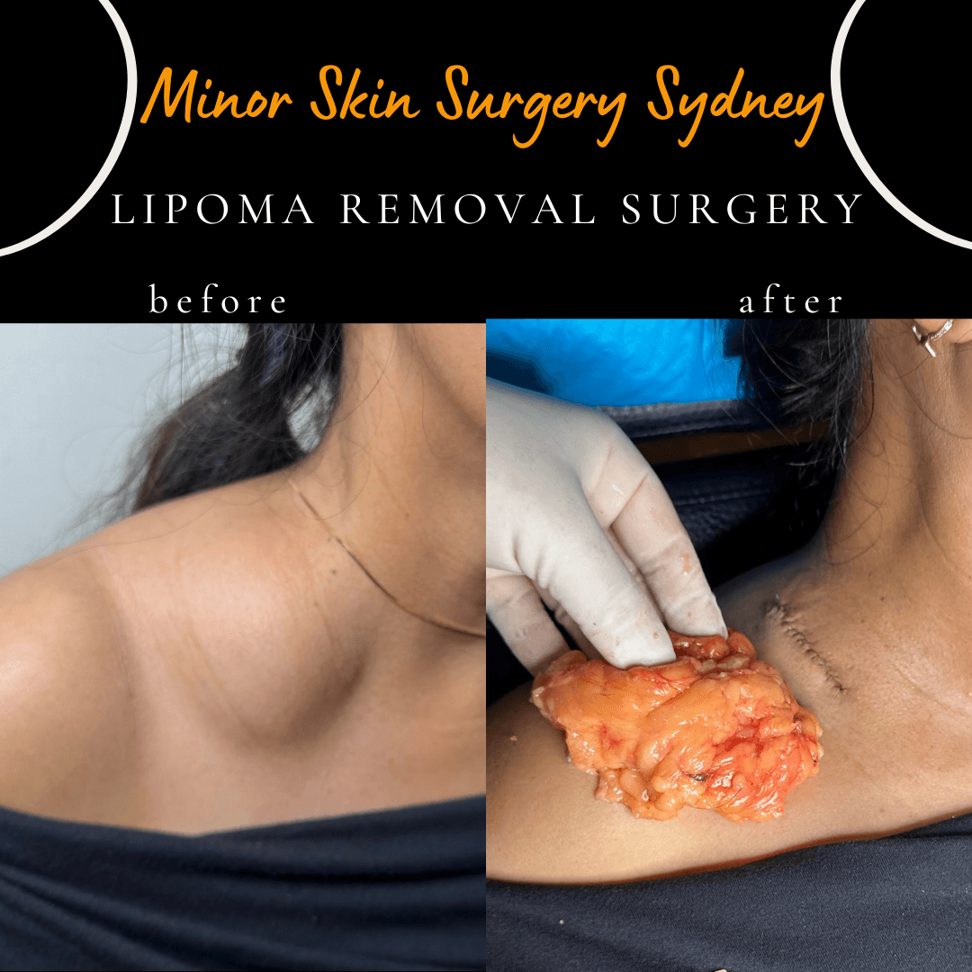 before after photo of lipoma surgery neck under local anaesthesia 