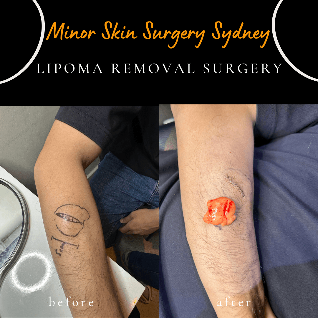 before after photos of lipoma surgery in forearm and possibility of developing keloid scar