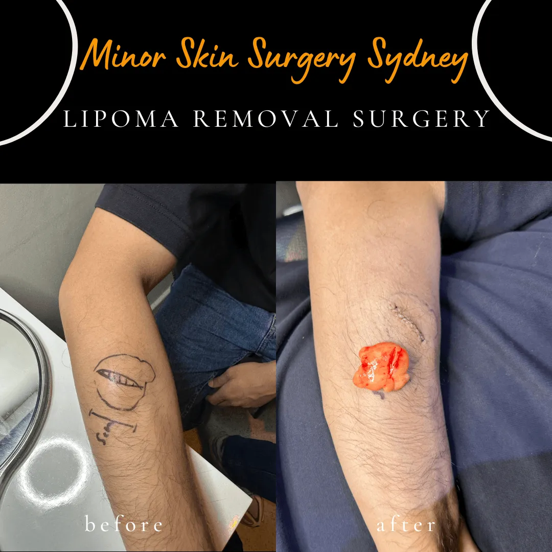 Large arm lipoma before and after removal under local anaesthesia in a patient prone to keloid scars