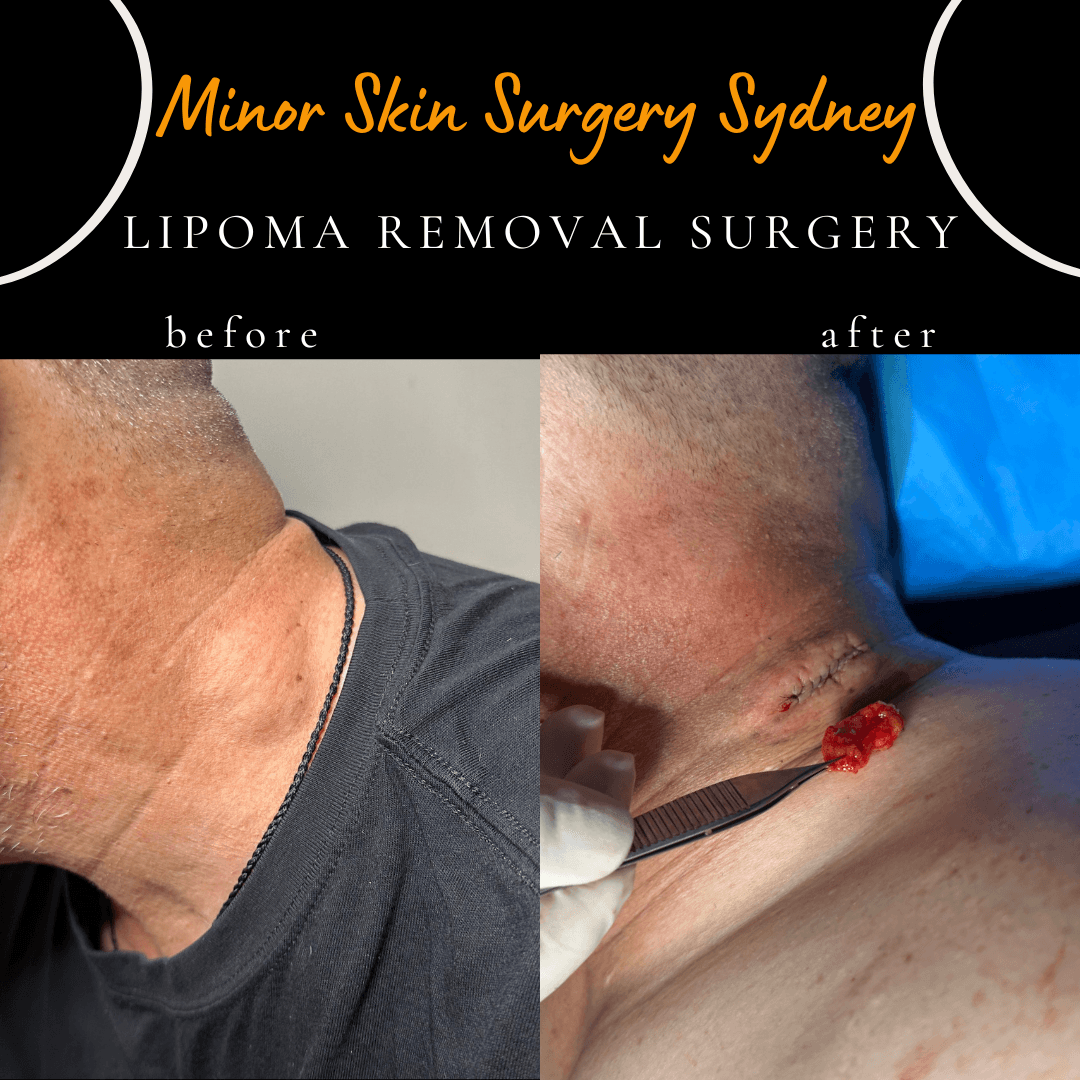 before after photo of lipoma surgery neck in sydney