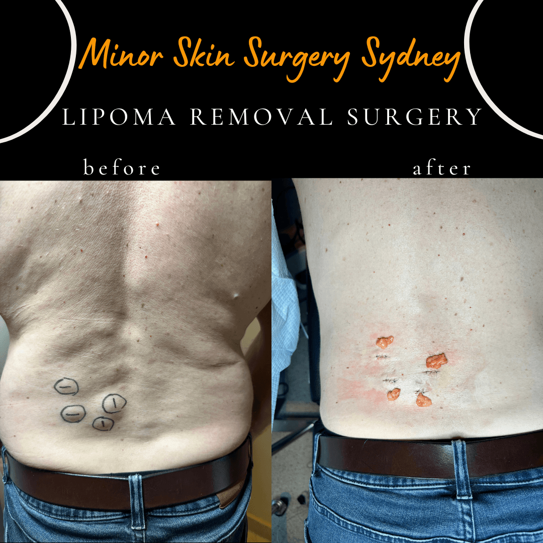 Before and after photo lipoma surgery back multiple