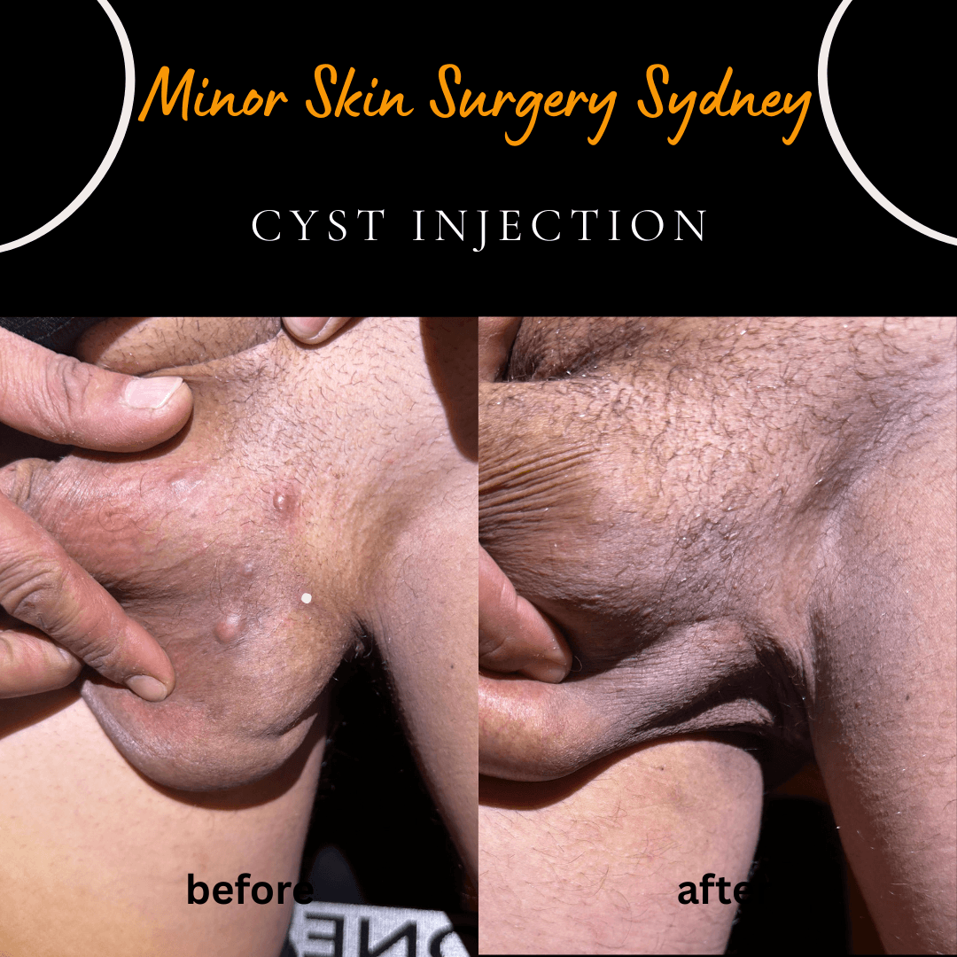non surgical cyst treatment with injection dr peter kim sydney
