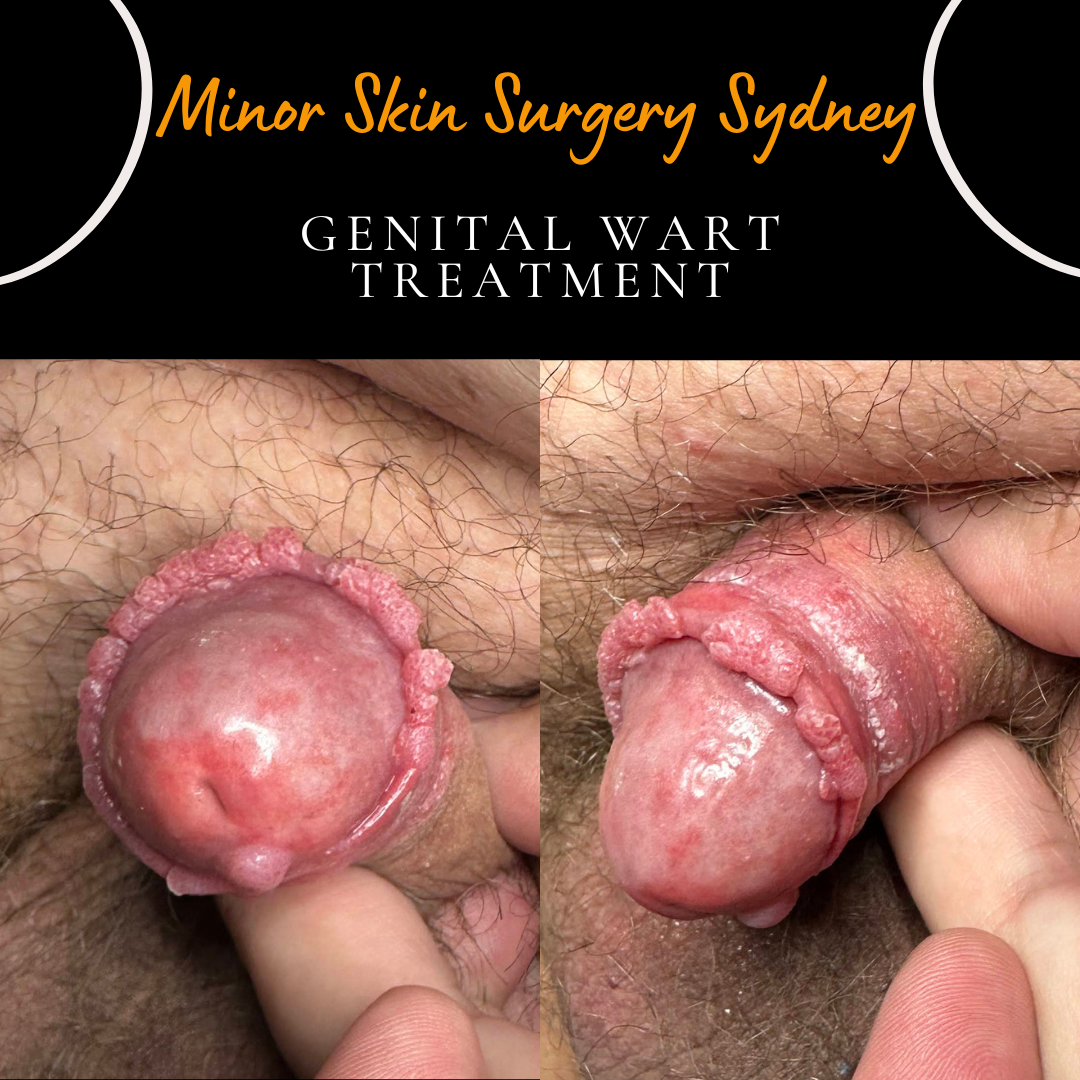 5-year history of genital warts with poor response to cryotherapy and multiple topical treatments. The lesions progressively increased in size and number despite treatment. These warts were subsequently treated using our laser genital wart treatment.