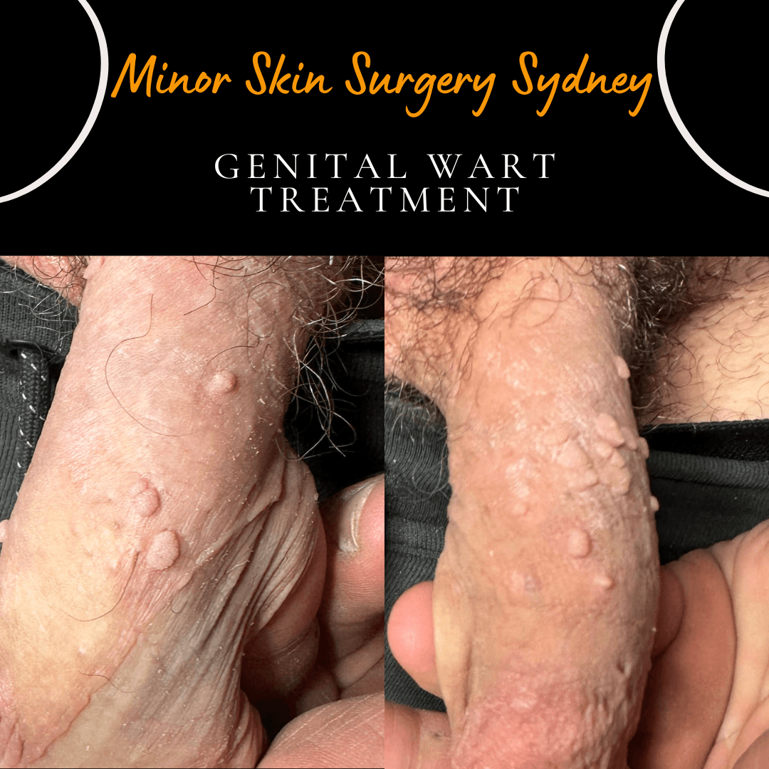 Resistant genital warts treated with advanced laser technology.
