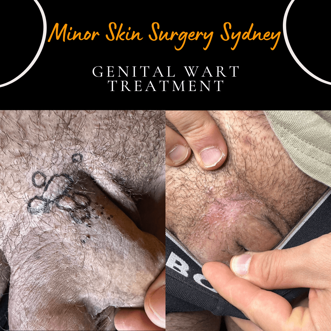 Three months after laser treatment of a longstanding genital wart that was resistant to cryotherapy and topical creams. The wart has completely resolved, with mild residual redness expected to fade over time