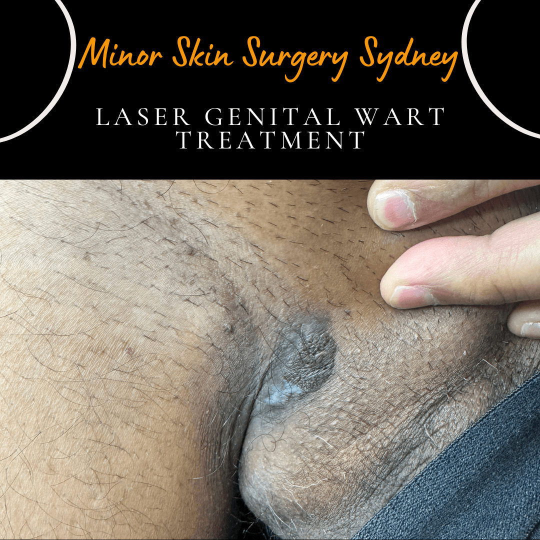This wart had been present in the genital area for 18 months. The patient was initially advised by their GP not to worry, but the lesion persisted despite treatment with prescription creams. It is important to note that this was a common wart located in the genital region and not a sexually transmitted genital wart. Laser treatment is an effective option for resistant warts, and the patient was able to receive treatment on the same day.