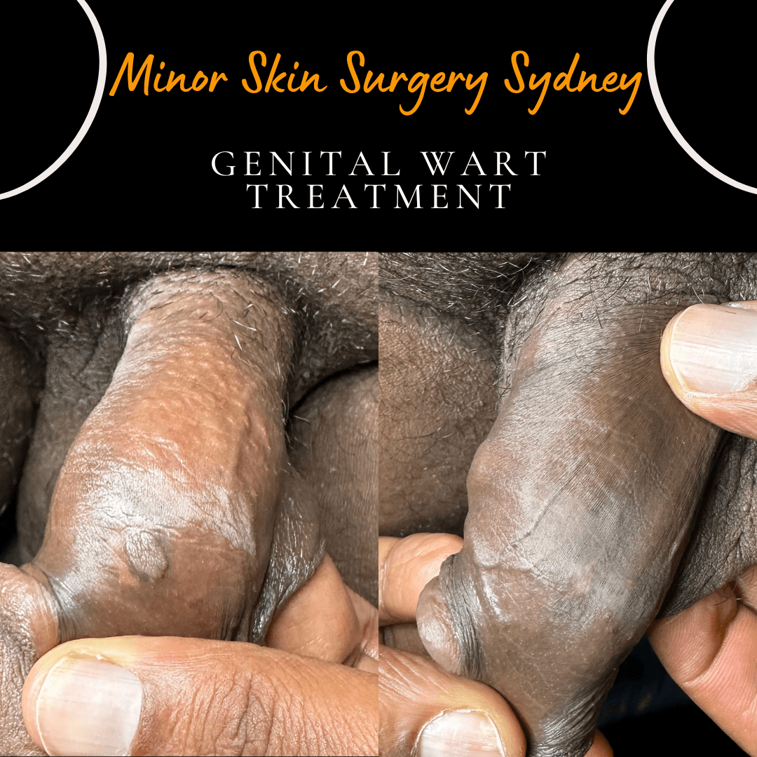 before after photo after laser treatment of genital wart