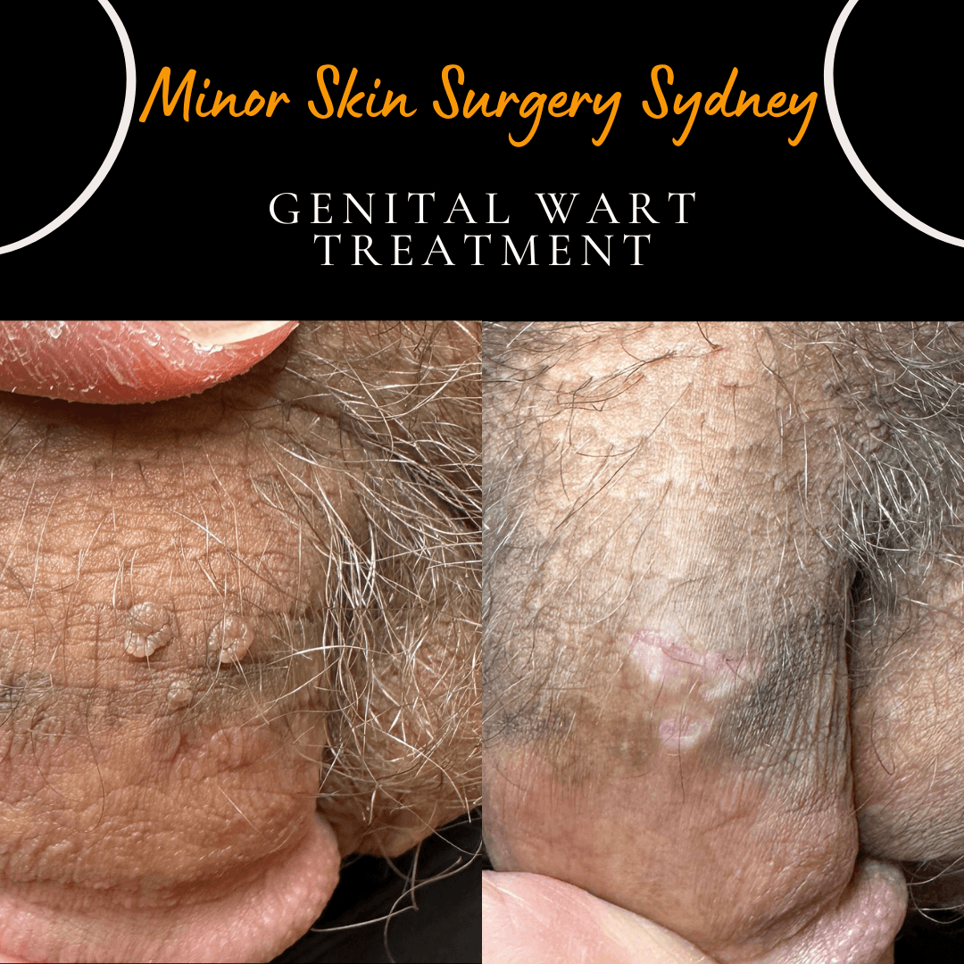 Before and after photos showing successful laser genital wart removal treatment performed by Dr Peter Kim in Sydney. Images demonstrate clearance of genital warts following treatment with minimal residual skin changes.