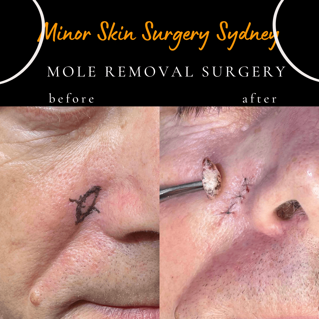 before after photo of mole removal surgery face