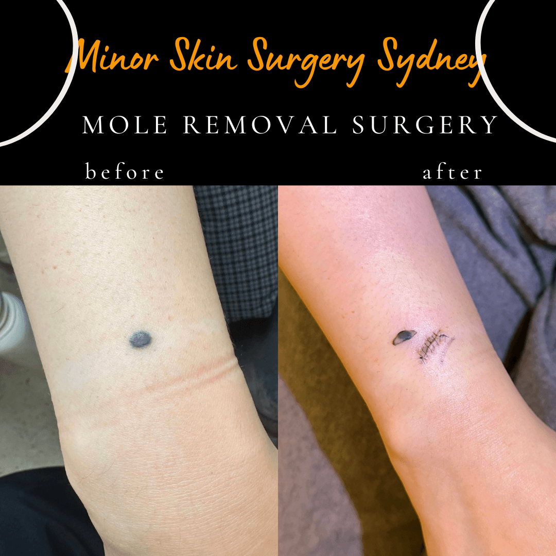 before after mole removal surgery in sydney under local anaesthesia by Dr Peter Kim