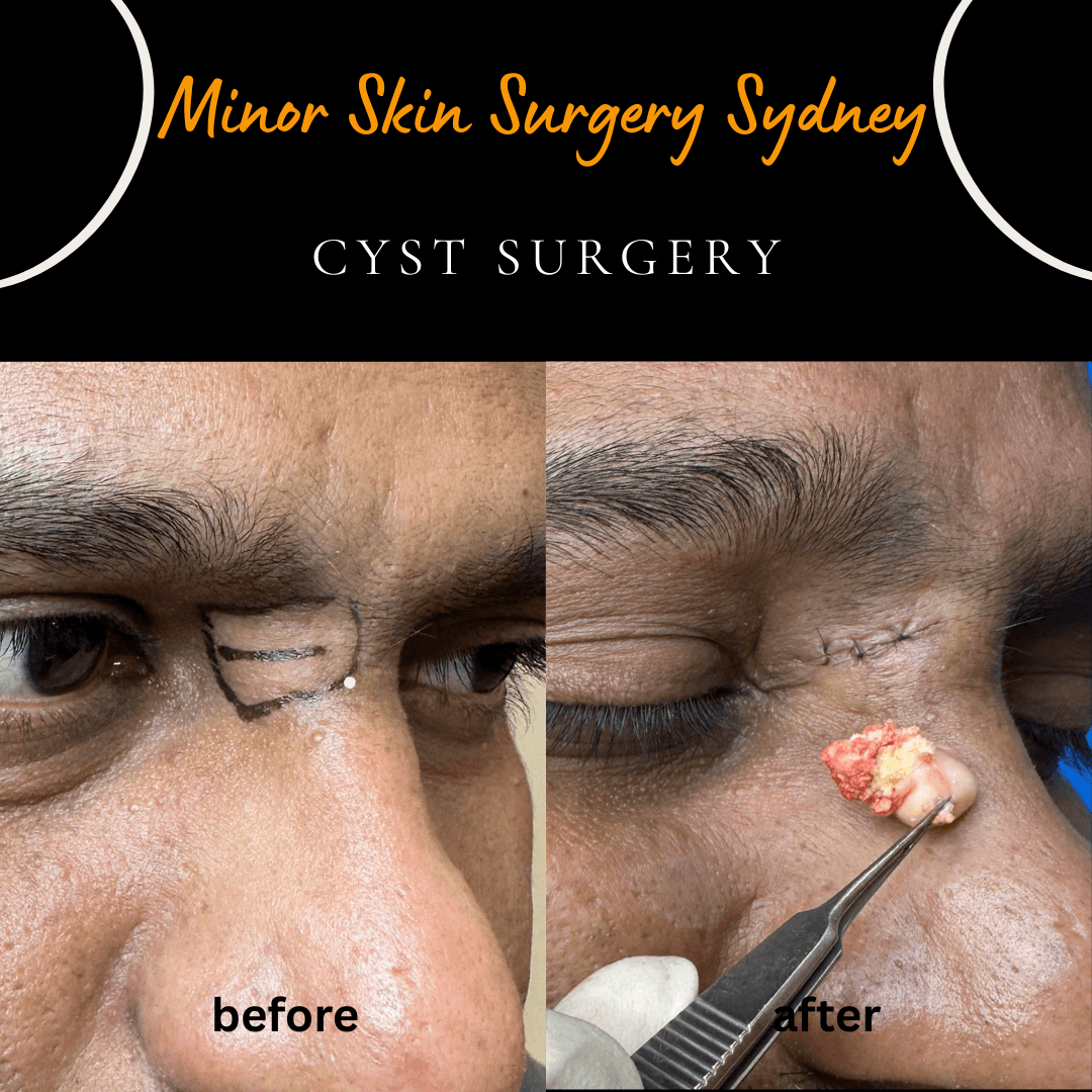 before after photo of sebaceous cyst surgery on the nose and eyelid in sydney, cabramatta clinic