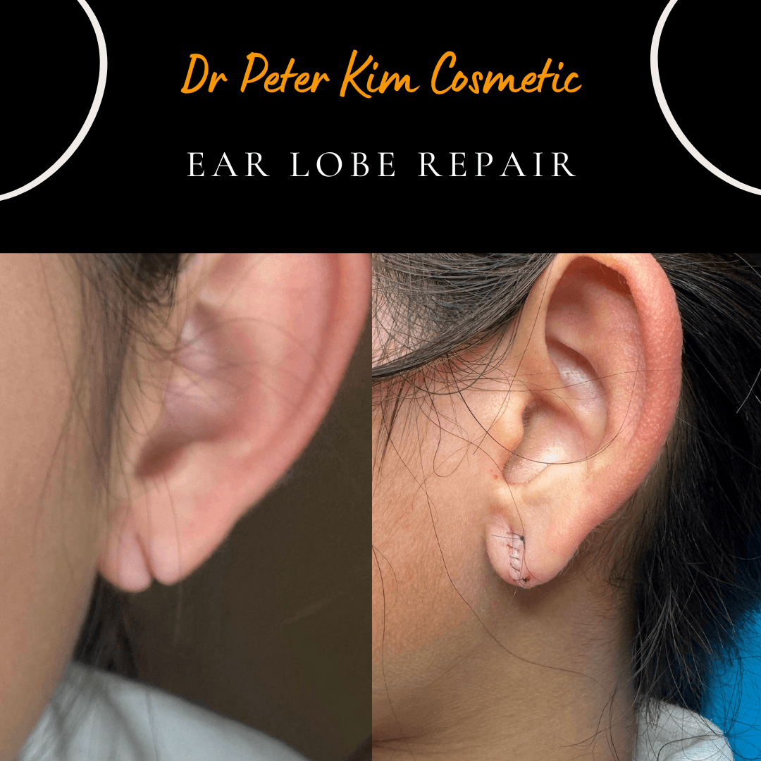before and after photo of earlobe repair by dr peter kim on torn ear