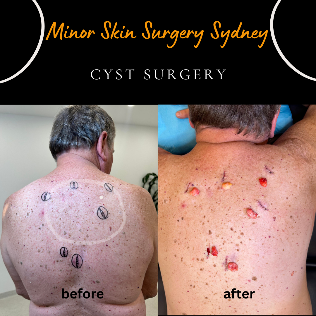 Before and after removal of six epidermoid cysts from the back under local anaesthesia, including recurrent cysts previously treated with surgery.