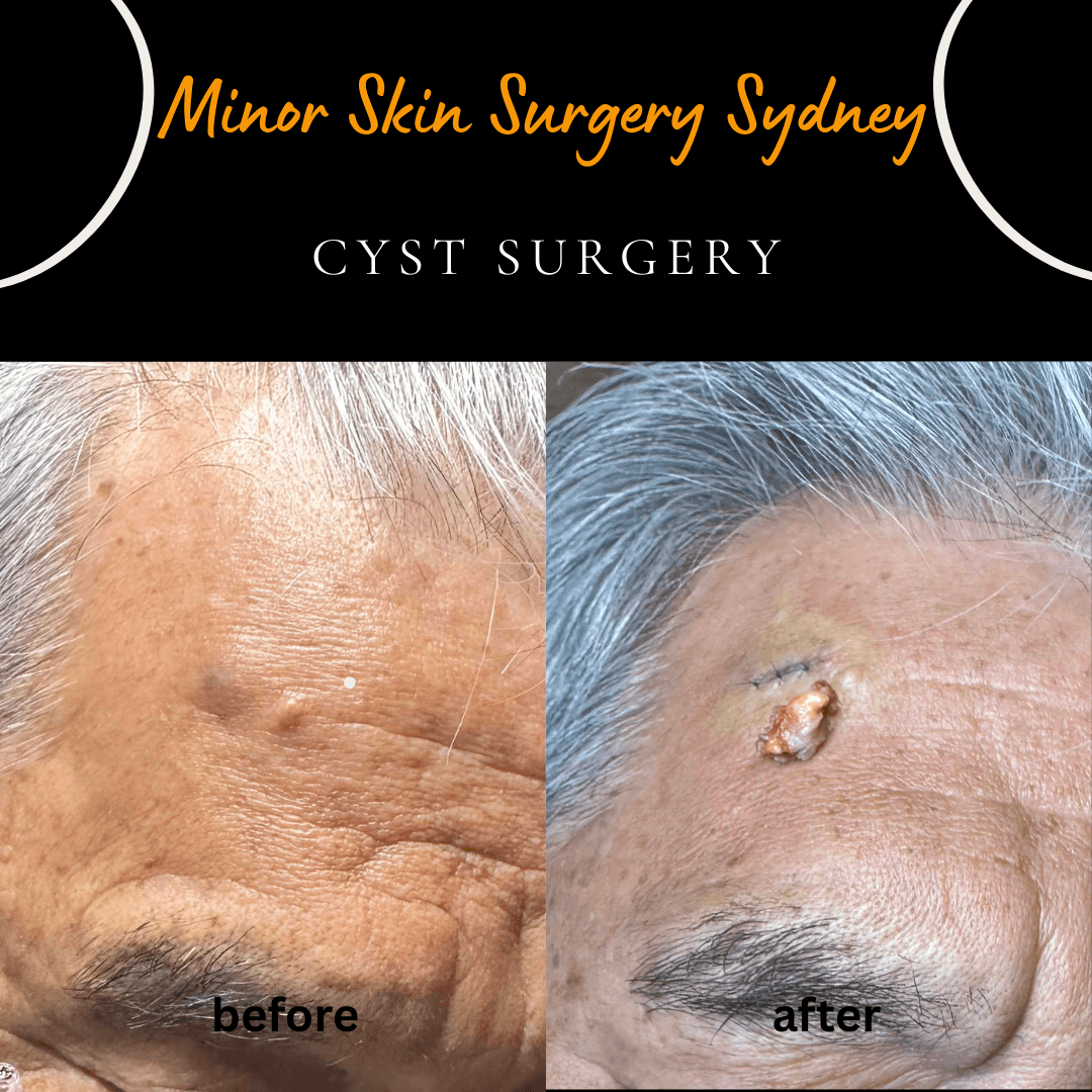 Forehead cyst before and after surgical removal by Dr Peter Kim in Sydney