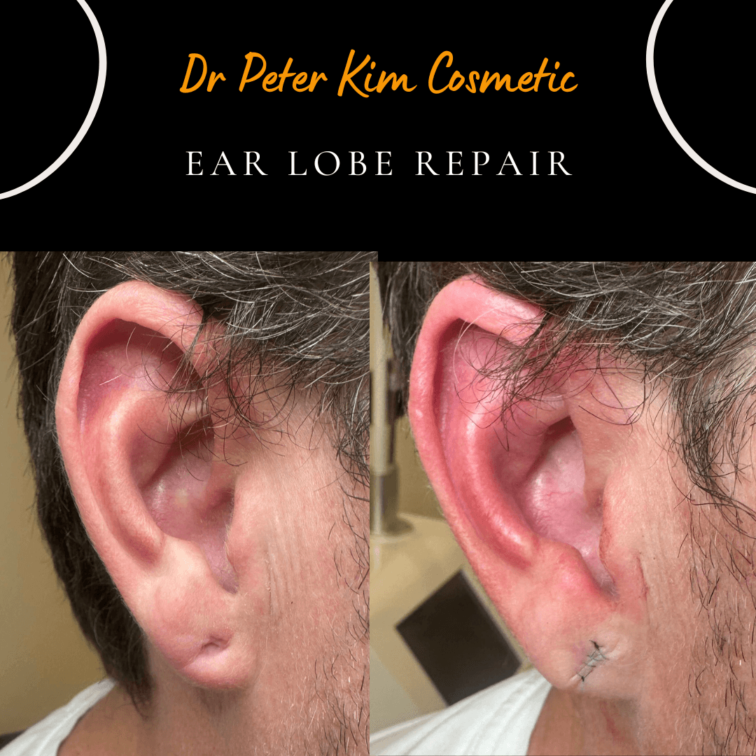 Before and after photographs showing repair of an enlarged earring hole in the earlobe. The torn earlobe was surgically repaired under local anaesthesia with fine sutures, restoring a natural earlobe shape. The procedure was performed by Dr Peter Kim as a same-day minor surgical procedure.