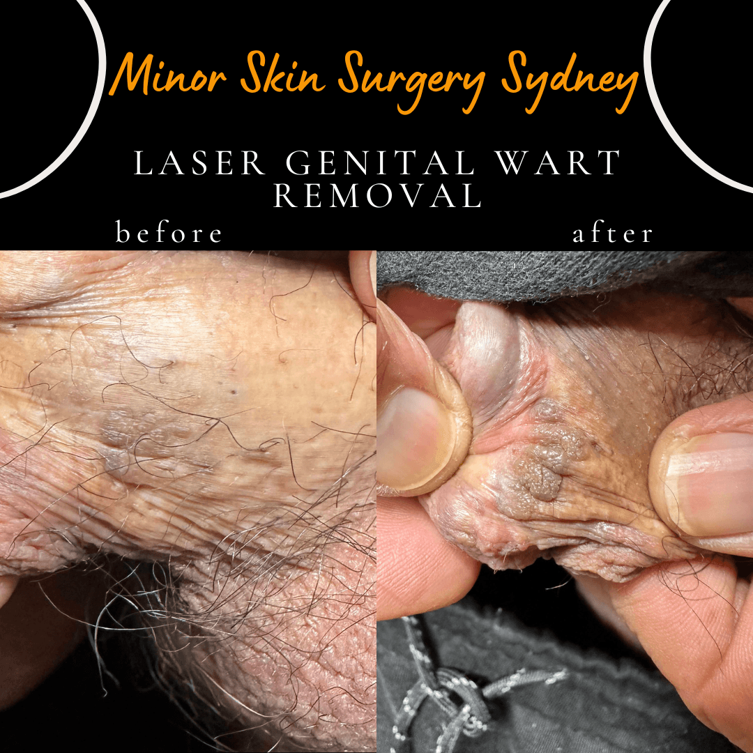 Penile skin area before and after CO2 laser treatment for large, treatment-resistant genital warts that failed cryotherapy and topical treatments.