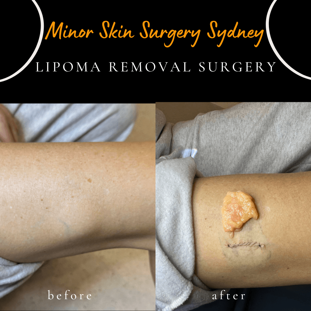 Before and after lipoma removal from the thigh performed under local anaesthesia by Dr Peter Kim.