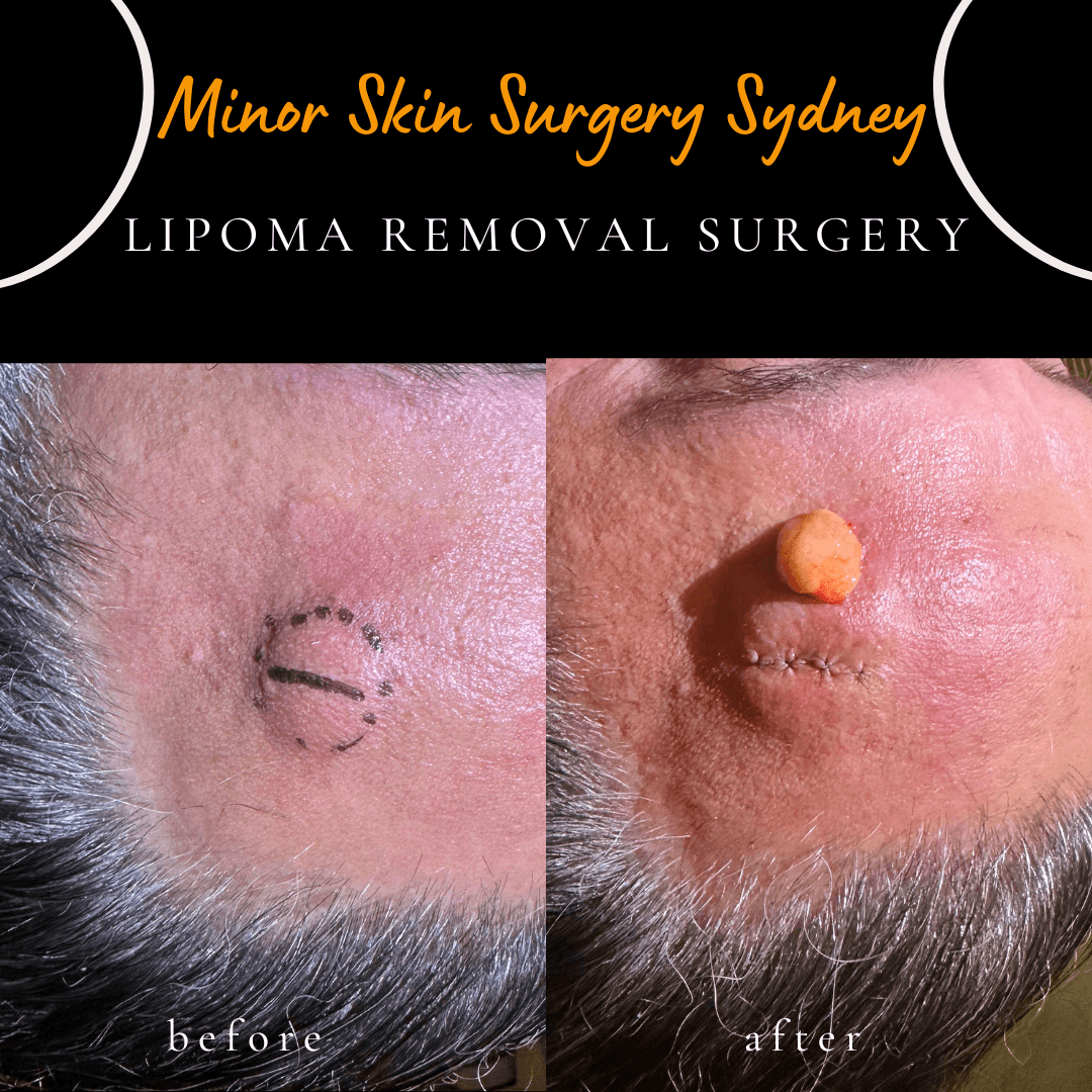 Close-up clinical photograph of a patient's forehead showing a raised, rounded subcutaneous lipoma that had been progressively enlarging over several years prior to surgical excision.