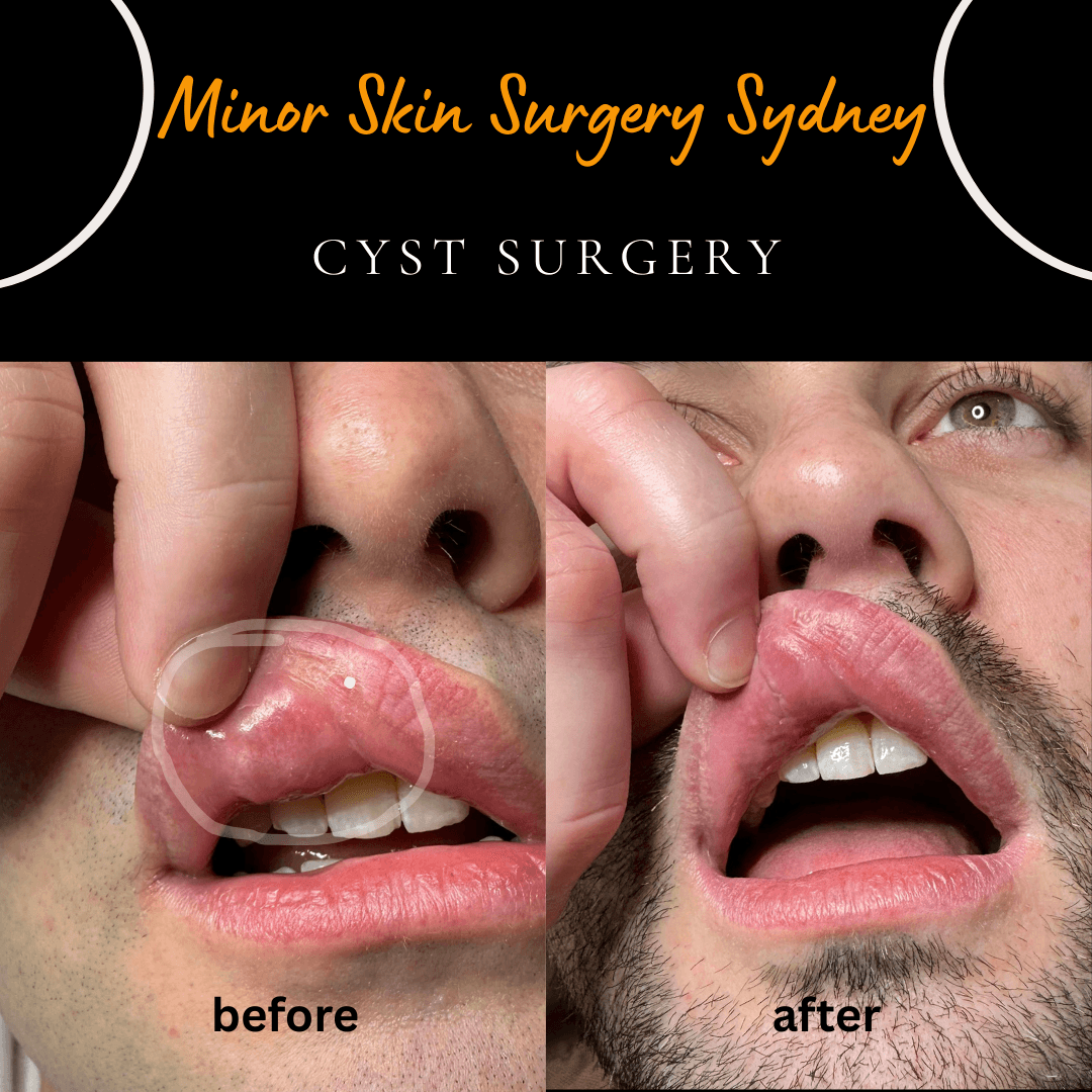 Before and after surgical removal of a large upper lip mucocele (mucous cyst) performed under local anaesthesia by Dr Peter Kim.
