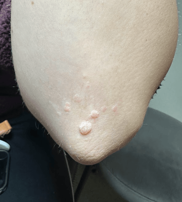 Clinical photograph of a patient's elbow showing multiple clustered warts that had been present and recurring for over 10 years despite previous treatments with multiple modalities.