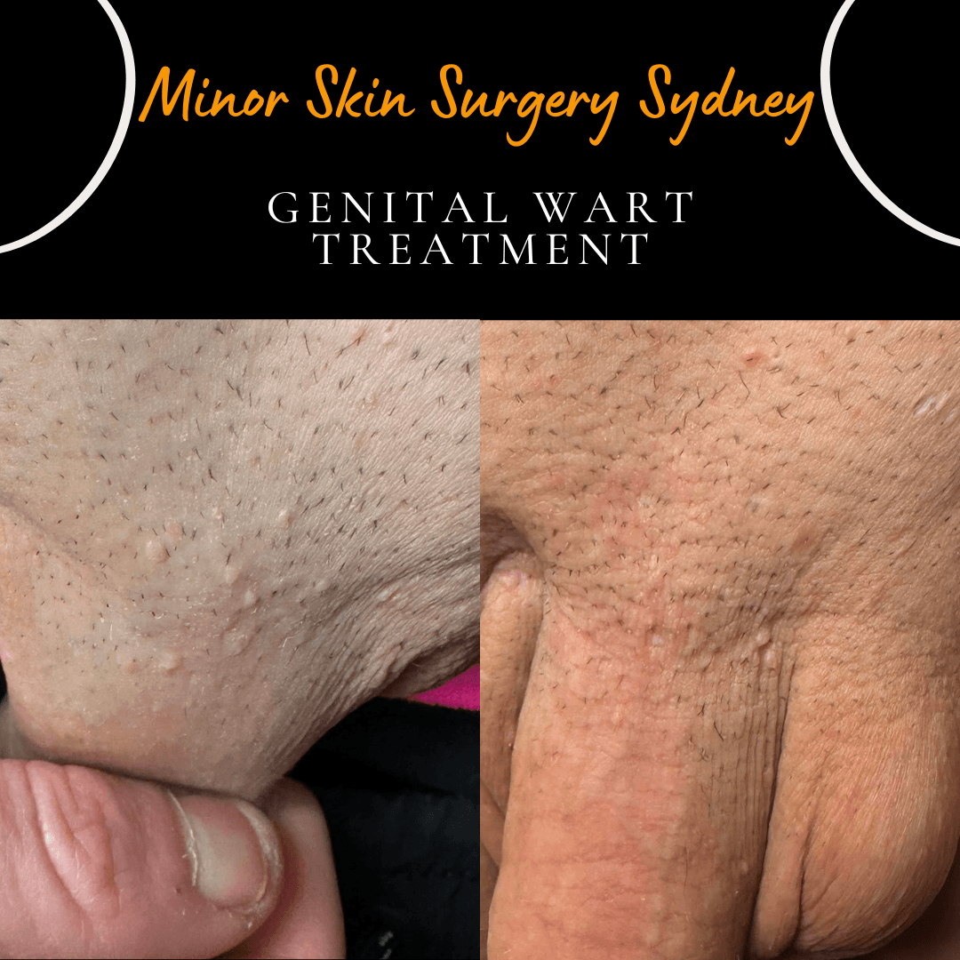Before and one year after CO₂ laser treatment of multiple genital warts in the pubic area showing complete clearance.