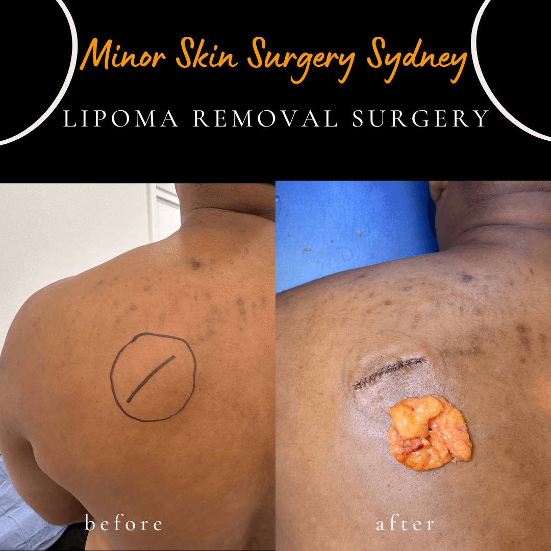 Before and after removal of a large lipoma from the back performed under local anaesthesia by Dr Peter Kim.