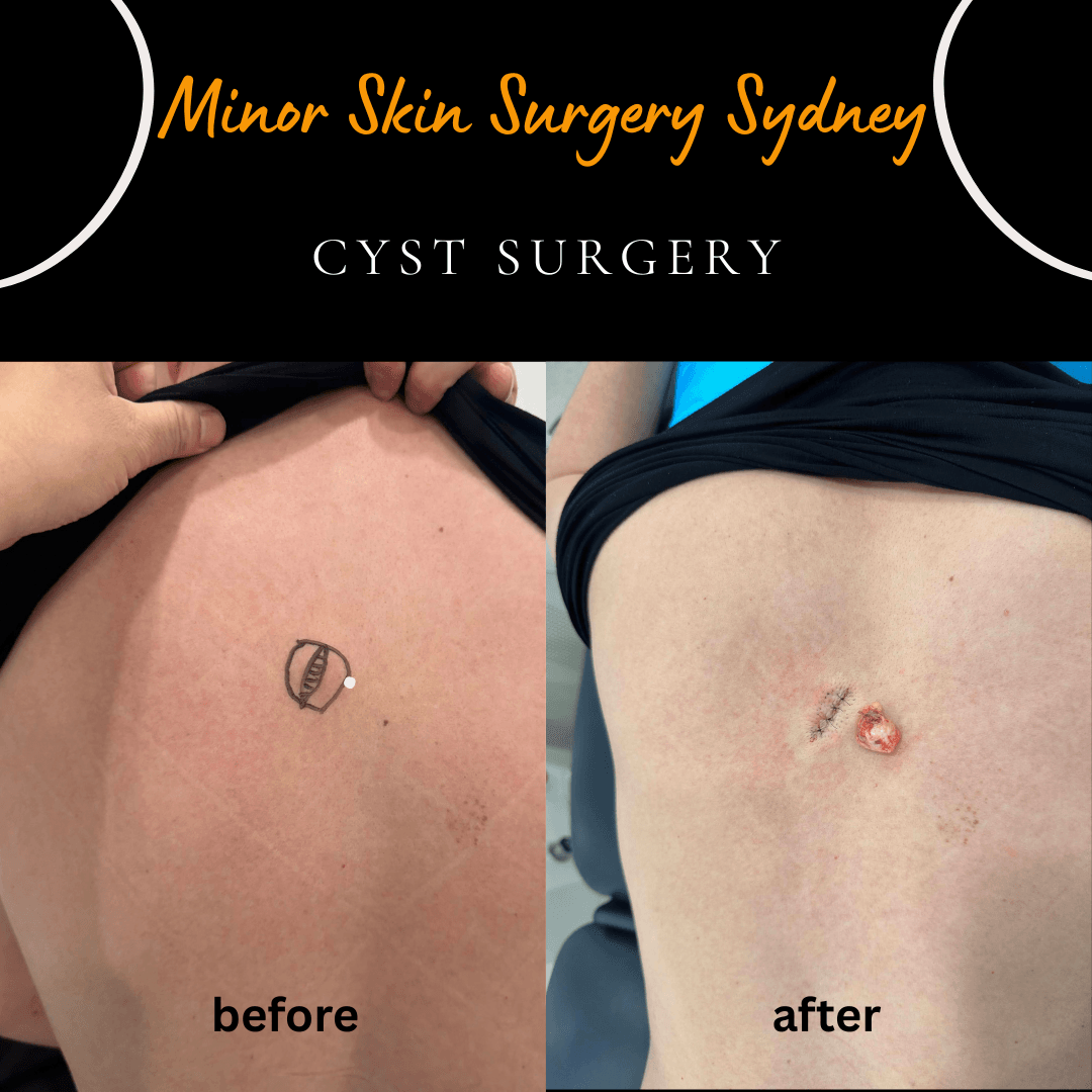 Surgical removal of a growing sebaceous cyst on the back under local anaesthesia following GP referral and ultrasound confirmation by Dr Peter Kim.