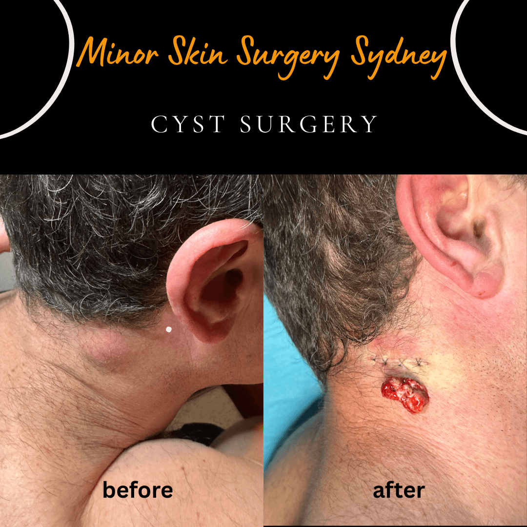 Surgical removal of a rapidly growing neck cyst under local anaesthesia during a same-day consultation at the Chatswood clinic by Dr Peter Kim.
