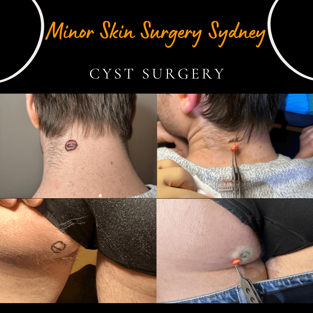Surgical removal of two cysts from the back of the neck and buttock performed under local anaesthesia in one day by Dr Peter Kim.
