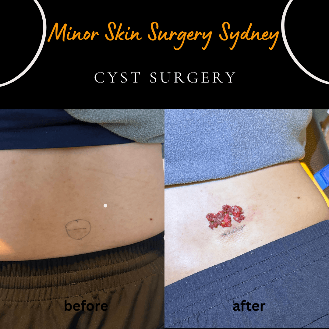 Removal of a ruptured cyst with multiple cyst wall fragments extracted under local anaesthesia by Dr Peter Kim.