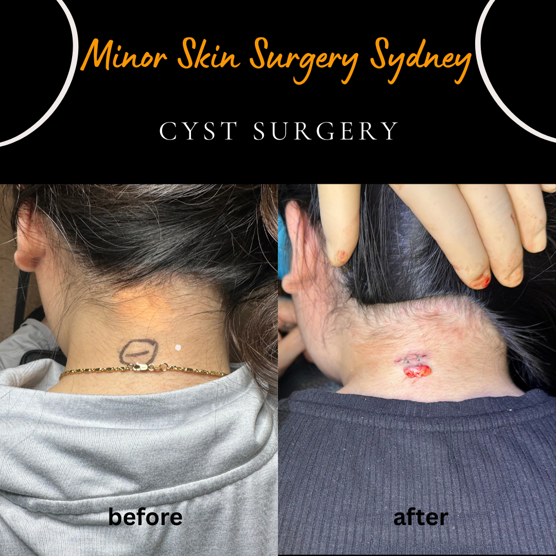 Surgical removal of a small, enlarging neck cyst under local anaesthesia performed by Dr Peter Kim.