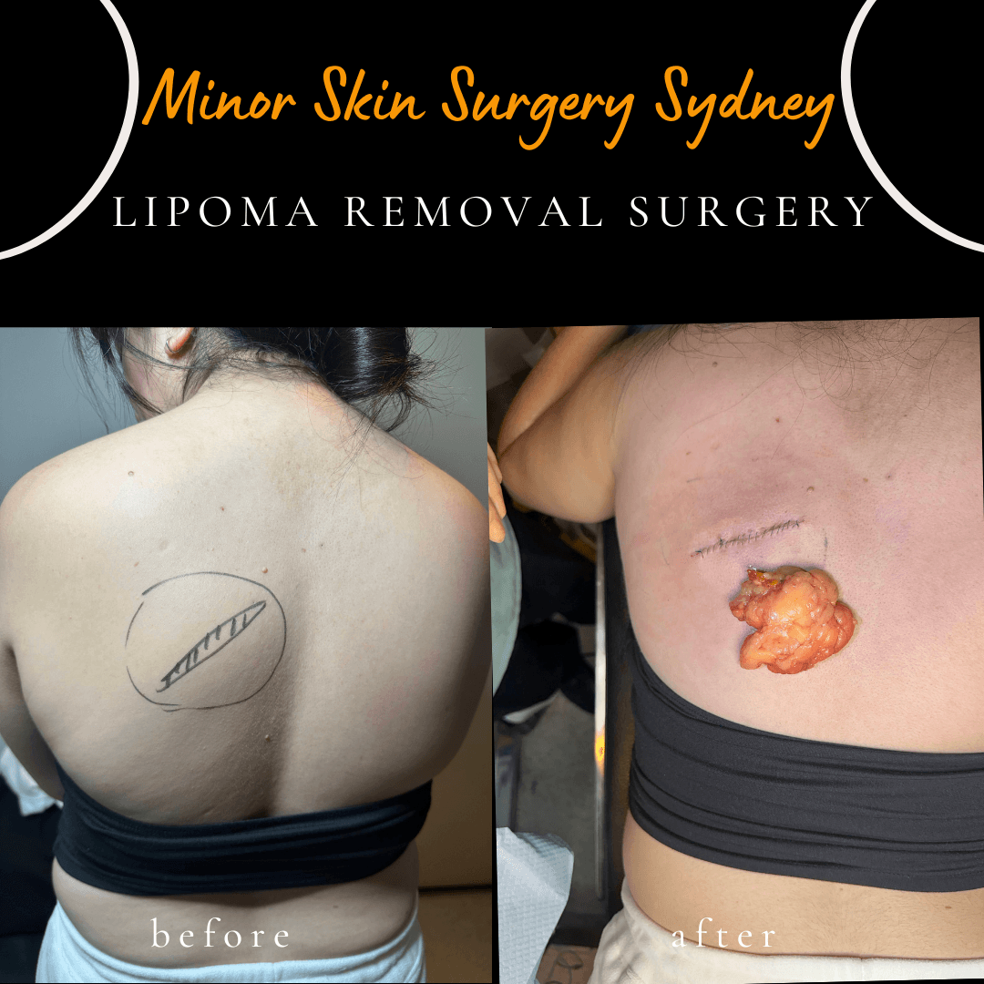 Surgical removal of a large lipoma on the back performed under local anaesthesia by Dr Peter Kim showing complete excision.