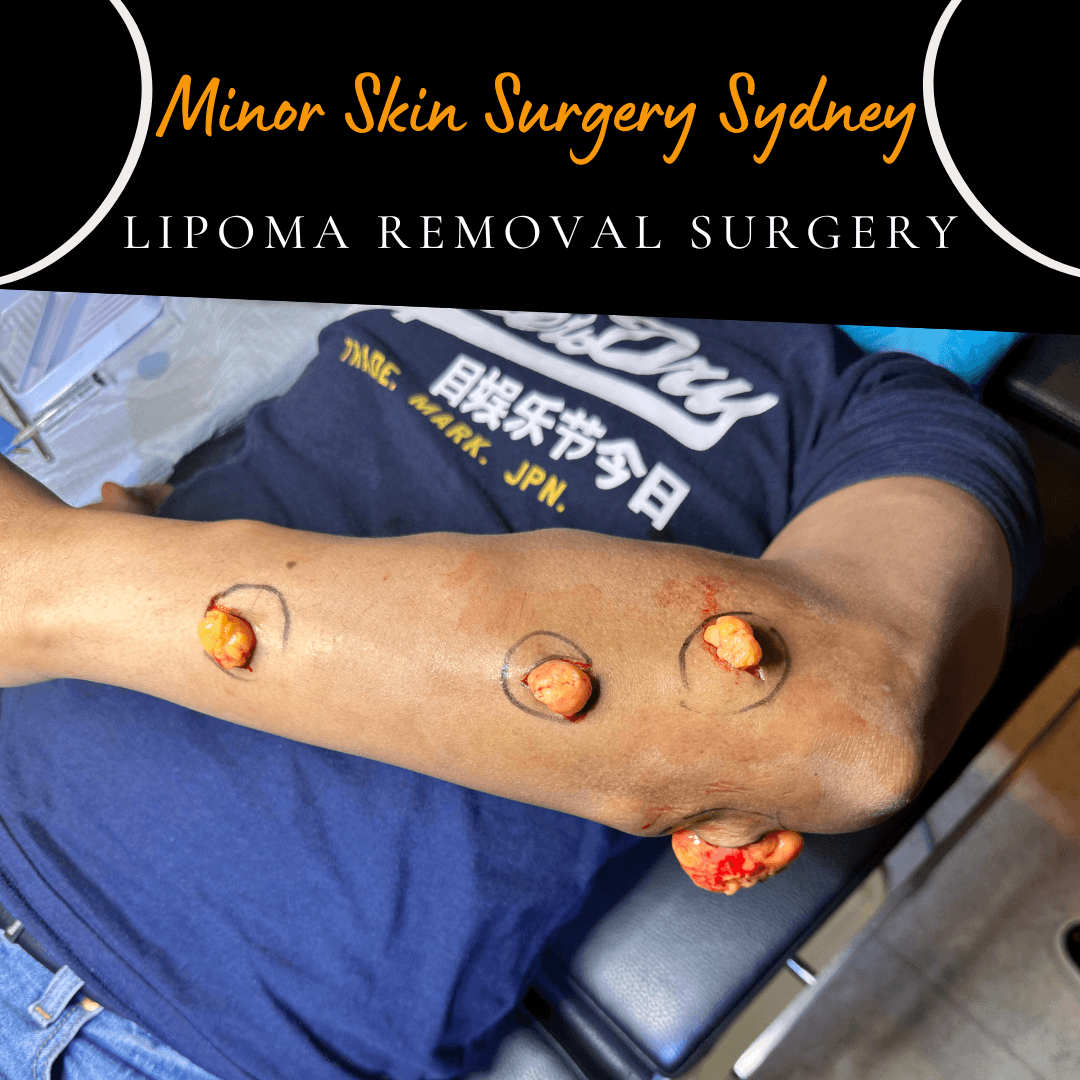 Surgical removal of multiple lipomas on the left forearm performed in one session under local anaesthesia by Dr Peter Kim.