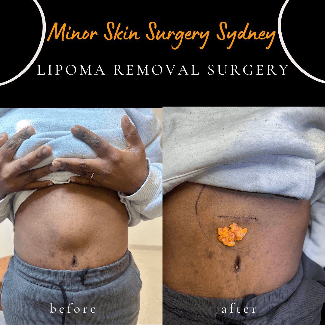 Large abdominal lipoma surgical removal performed under local anaesthesia by Dr Peter Kim showing complete excision.