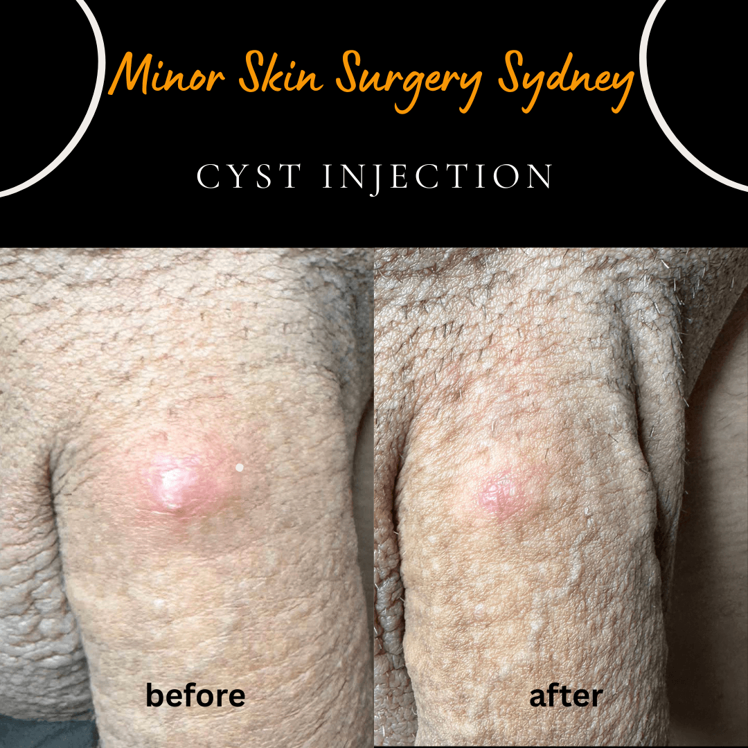 Non-surgical cyst injection treatment in penis and genital area used to shrink and resolve a skin cyst without surgery by Dr Peter Kim.