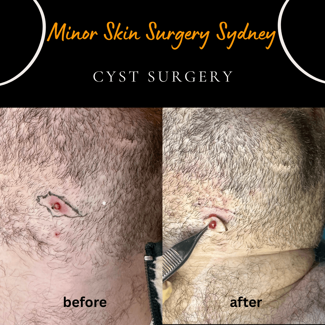 Surgical removal of a recurrent, previously infected chin cyst performed under local anaesthesia on the same day by Dr Peter Kim.