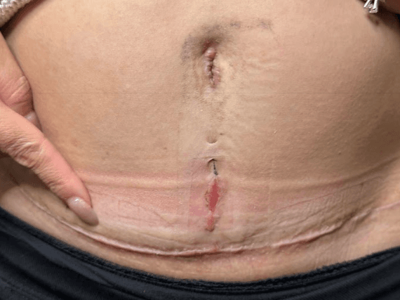 Treatment of a hypertrophic scar following abdominoplasty using scar injections, performed by Dr Peter Kim.