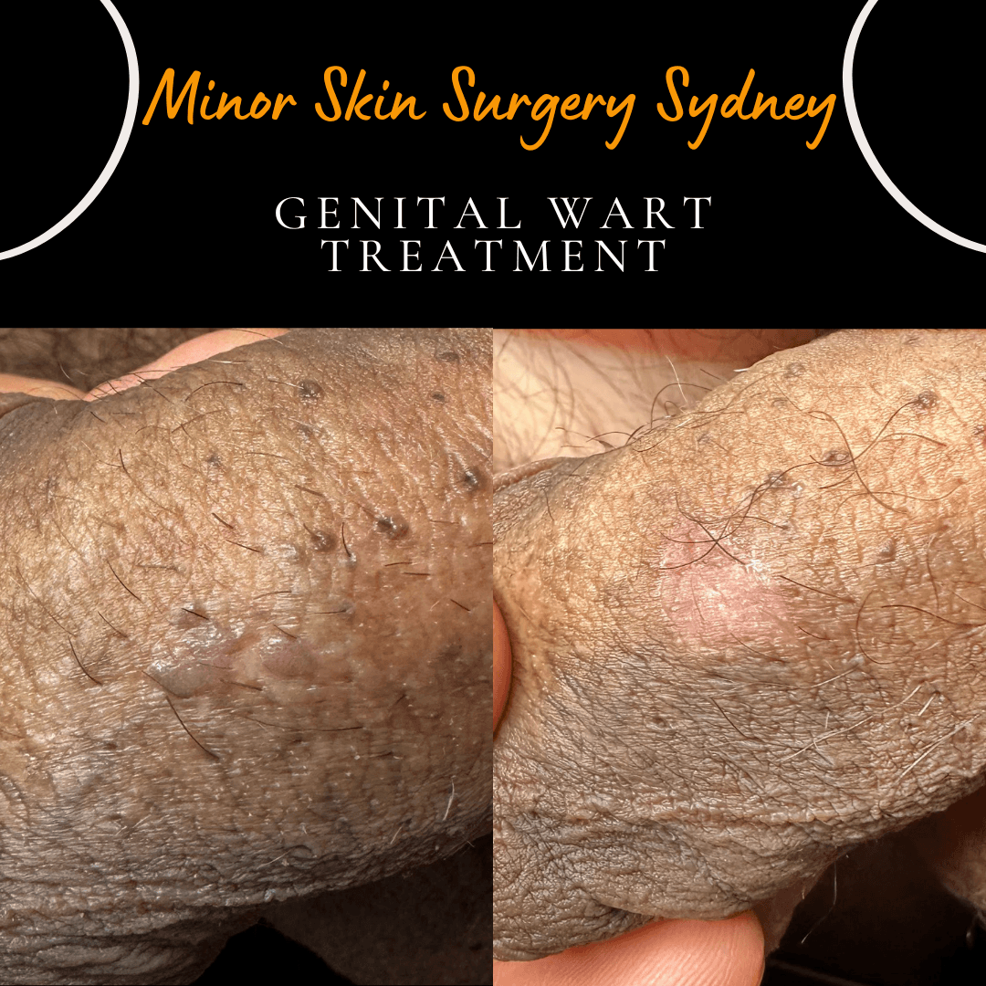 Before and after CO₂ laser treatment for multiple genital warts showing complete clearance 6 weeks after a single laser session following unsuccessful cryotherapy and Aldara cream treatment.