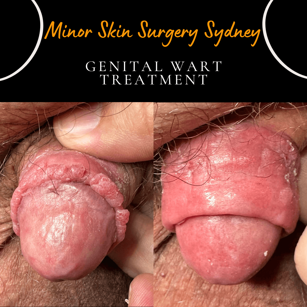 Dramatic improvement of extensive genital warts on the foreskin after medical laser treatment sessions by Dr Peter Kim.
