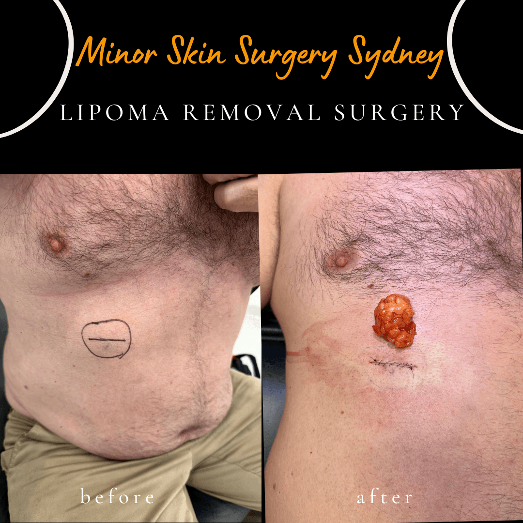 Surgical removal of a growing abdominal lipoma performed under local anaesthesia on the same day by Dr Peter Kim.
