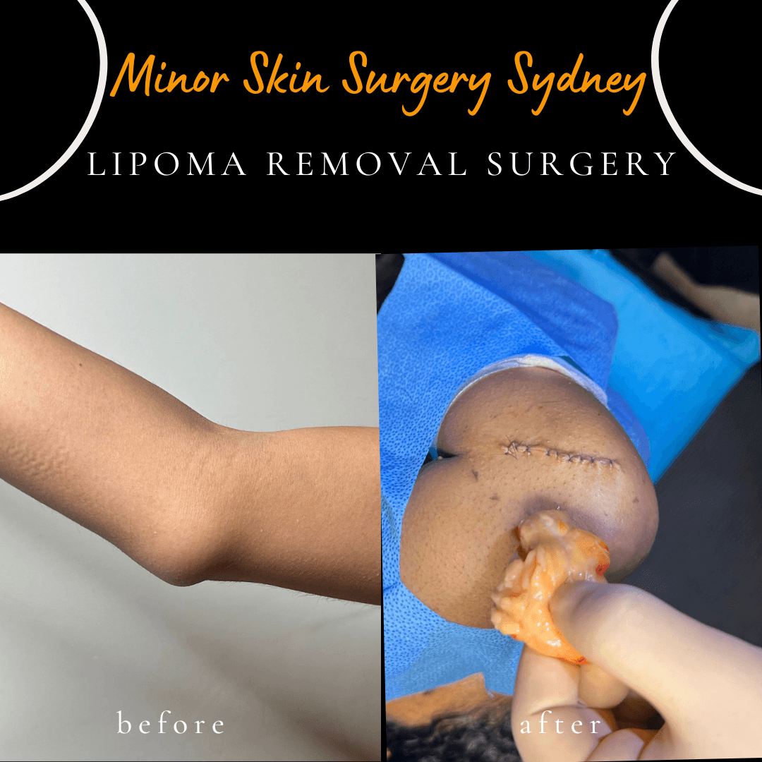 Surgical removal of a large lipoma pressing on a nerve performed under local anaesthesia on the same day by Dr Peter Kim.