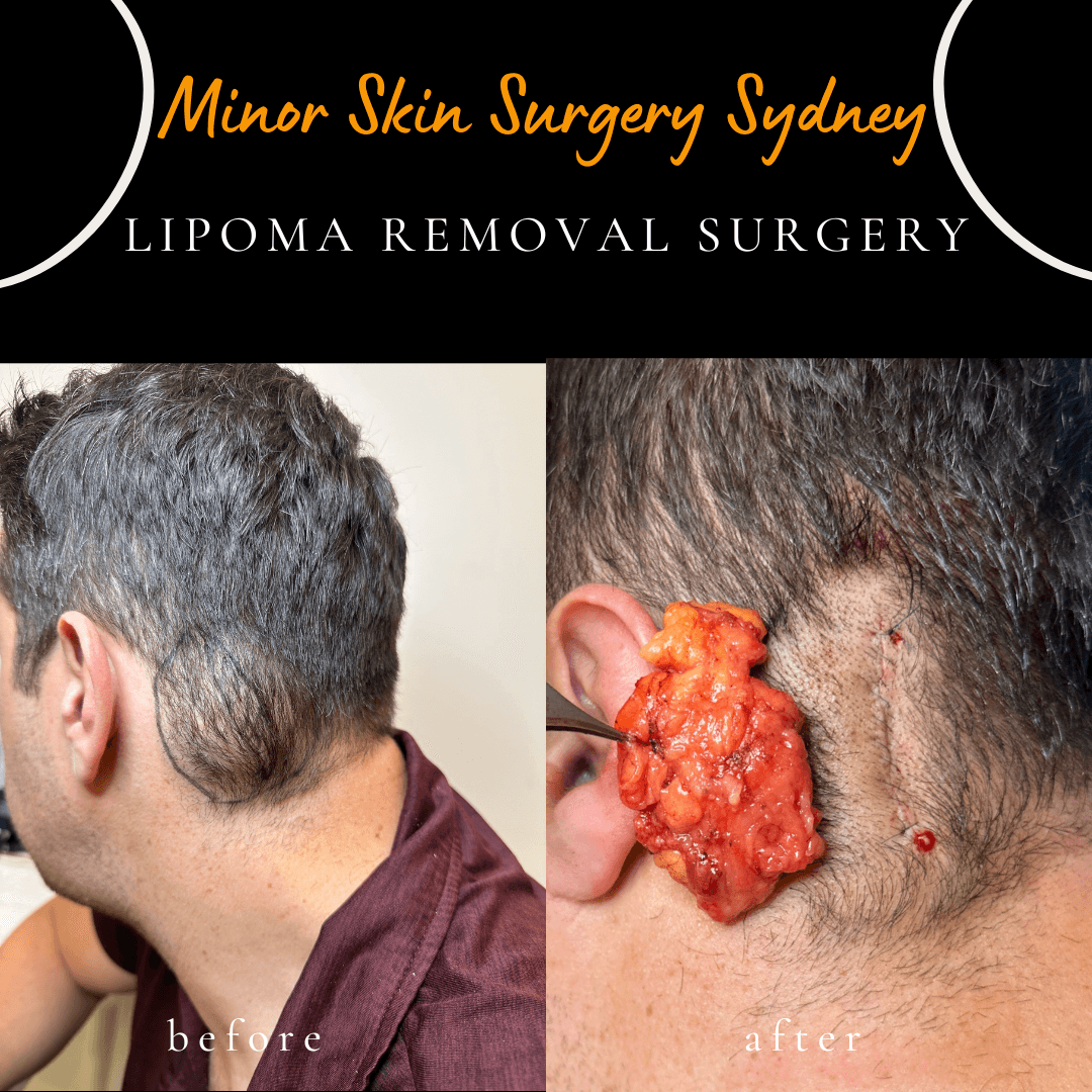 Large lipoma removal surgery performed under local anaesthesia by Dr Peter Kim showing complete excision with minimal scarring.