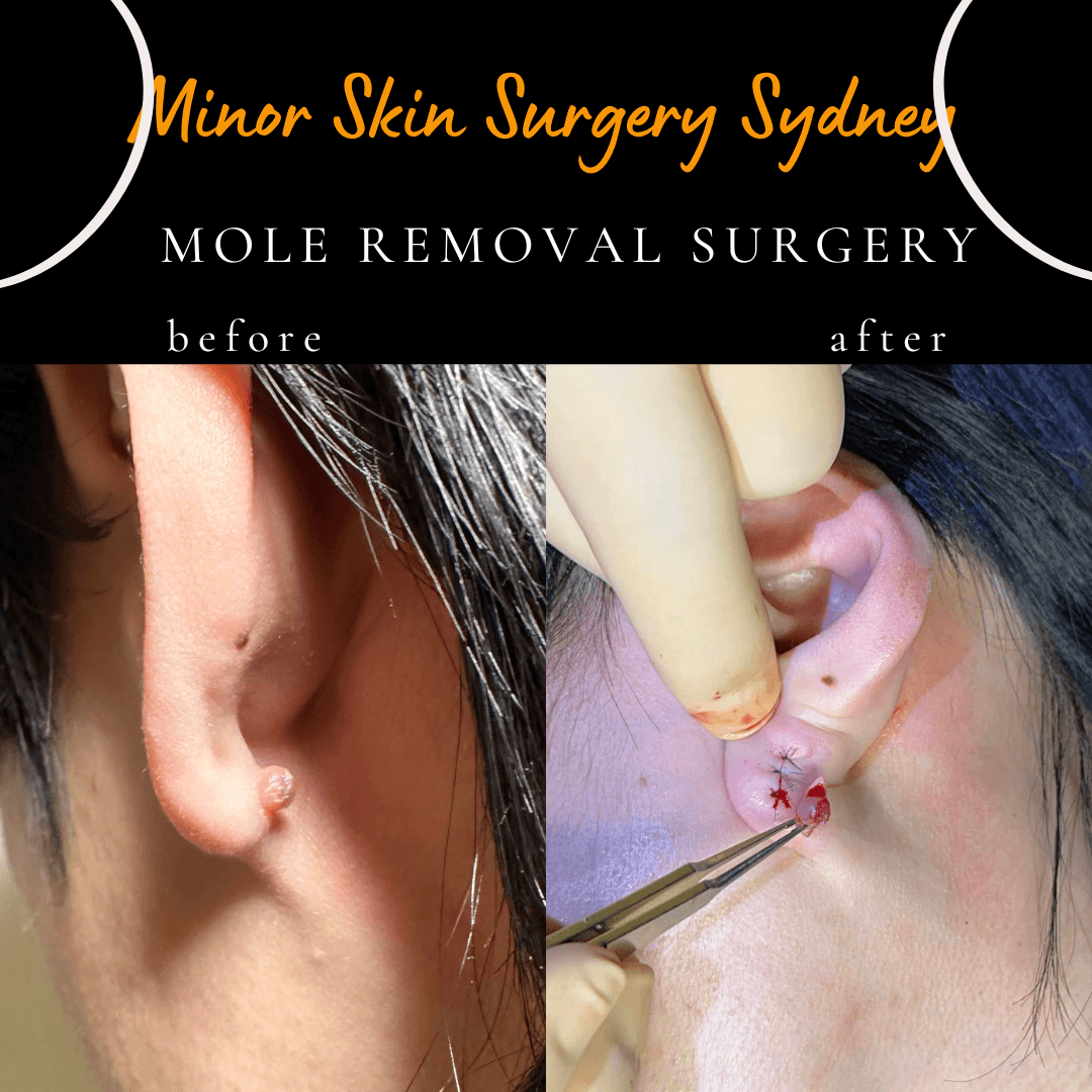 Earlobe mole removal procedure performed under local anaesthesia with cosmetic precision by Dr Peter Kim.