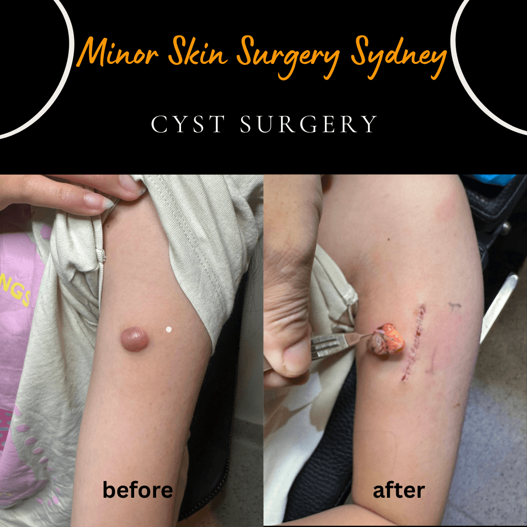 Surgical excision and pathology testing of a rapidly growing dermatofibroma mole under local anaesthesia with cosmetic suturing by Dr Peter Kim.