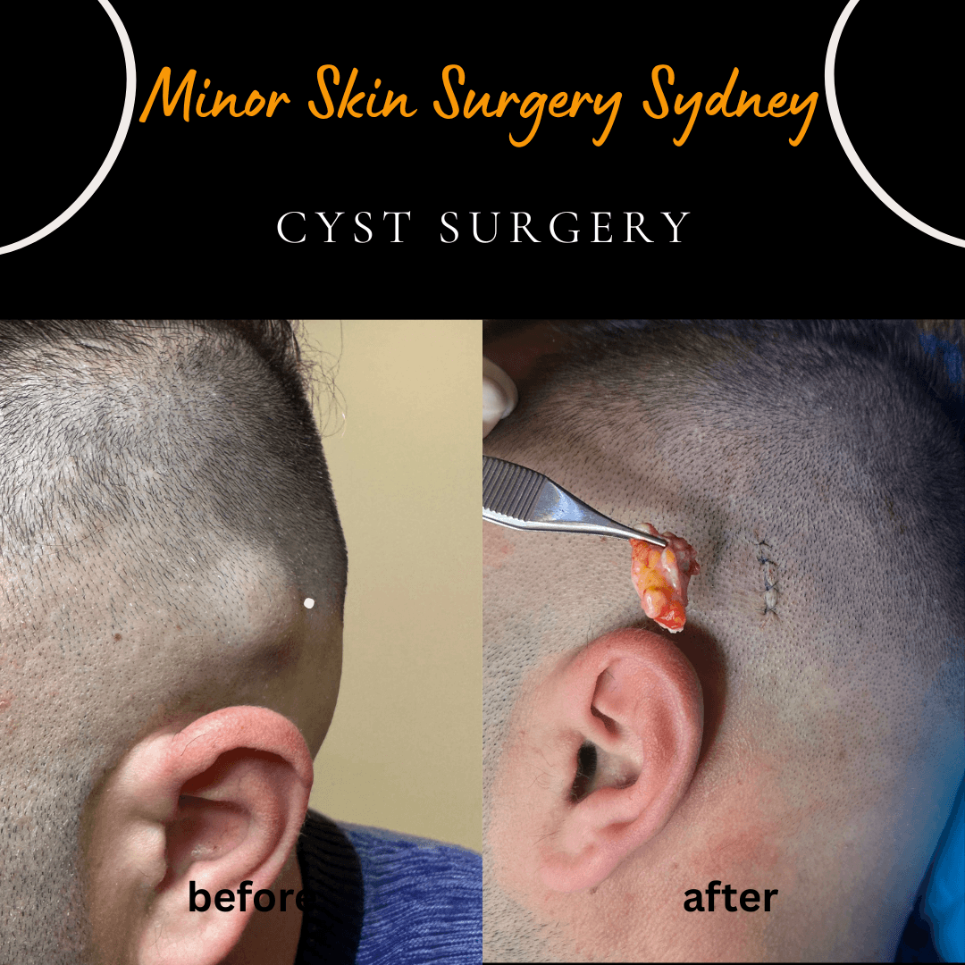 Surgical removal of a scalp cyst under local anaesthesia performed on the same day following GP referral by Dr Peter Kim.